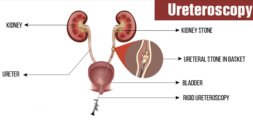 Urinary Stones