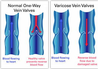 Varicocele