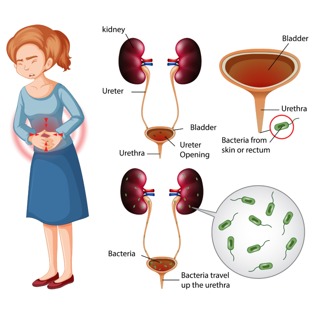 Don’t Let UTIs Spoil Your Summer Fun: Tips for Prevention and Treatment
