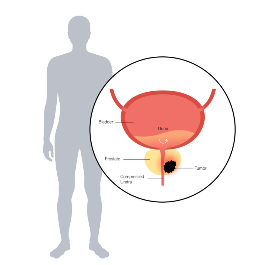 Spotting the Signs: How to Detect Prostate Cancer in its Early Stages