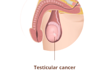 testicular cancer