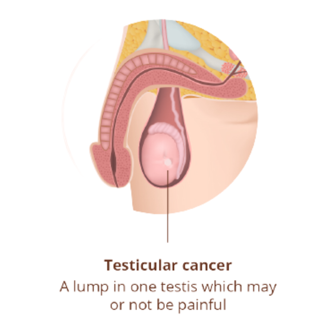 testicular cancer