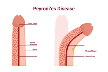 peyronie's disease