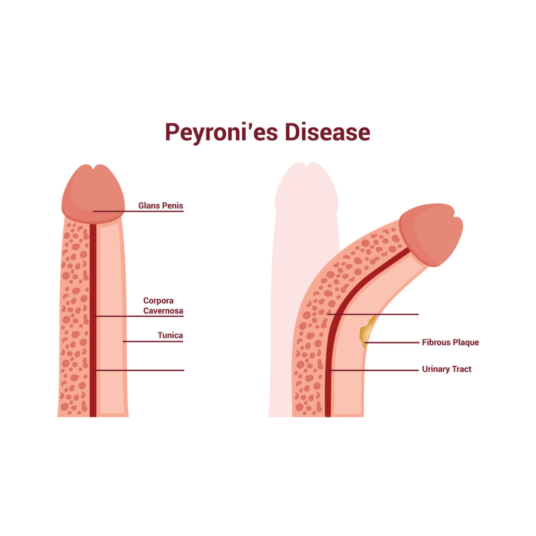 peyronie's disease