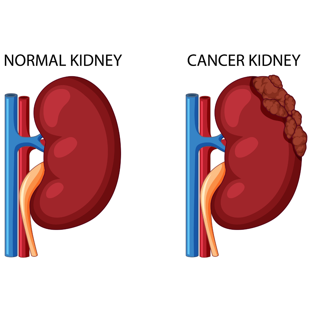 kidney cancer