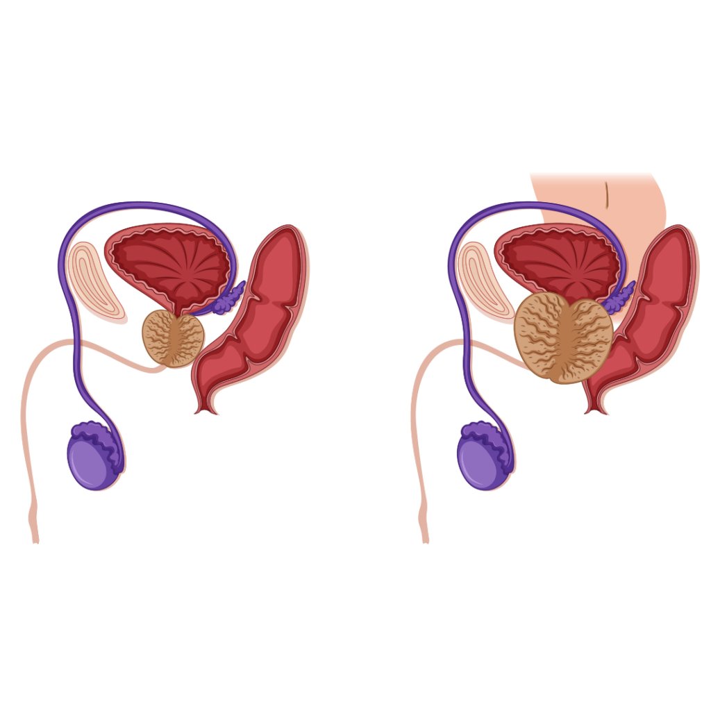 Understanding Prostatitis and Its Impact on Male Fertility