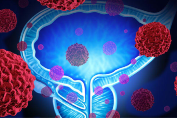 metastatic prostate cancer