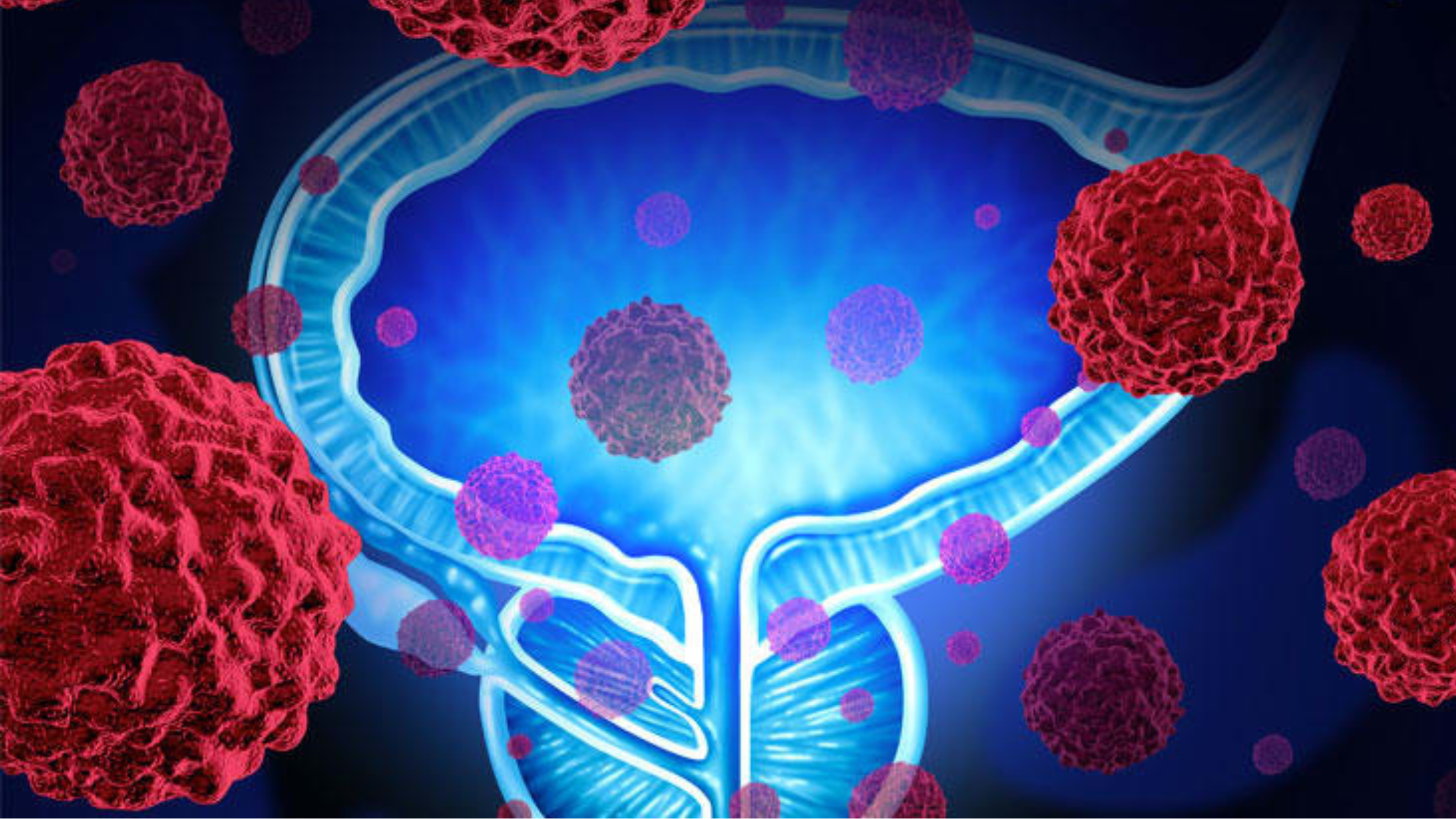 metastatic prostate cancer