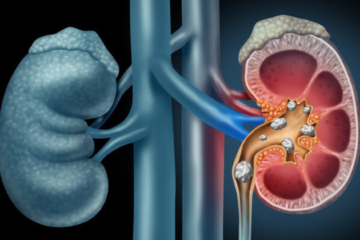 kidney stone surgery