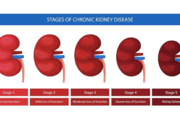 stages of chronic kidney disease